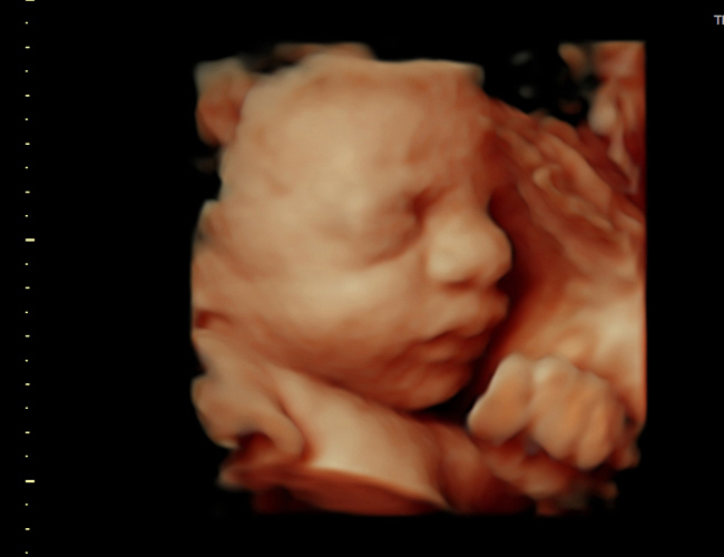 3D ultrasound image at 31 weeks